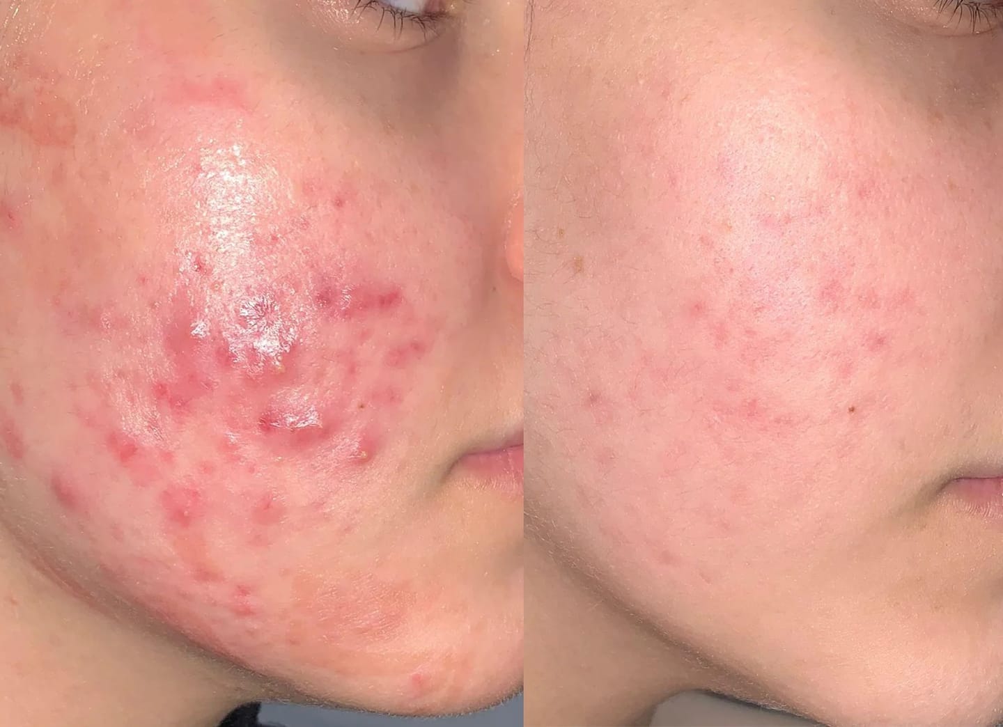 Customer photo review of Anti Acne Serum (Niacinamide & Azelaic Acid) (30ml)