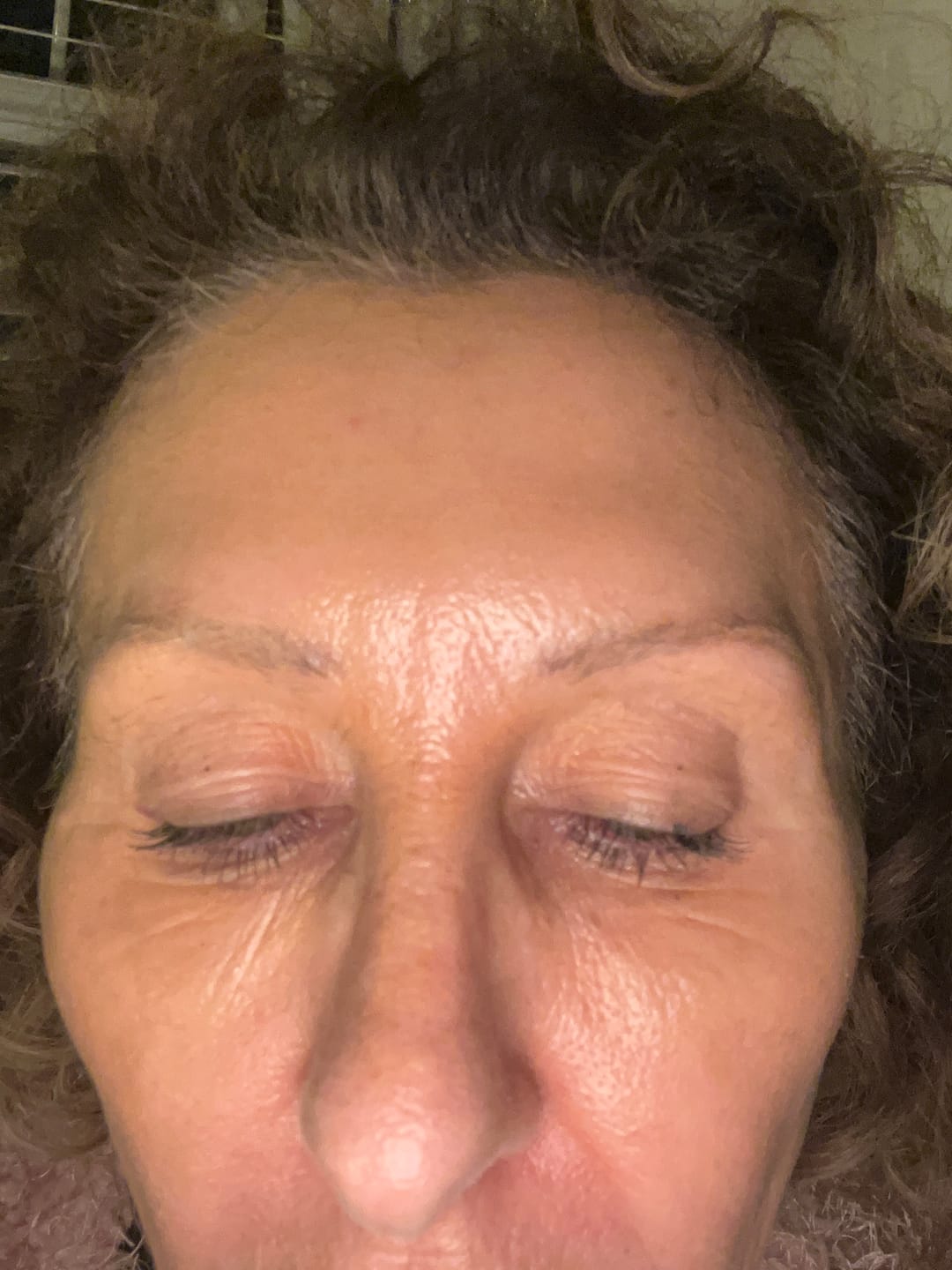 Customer photo review of Glov Serum-Infused Microneedle Eye Patches
