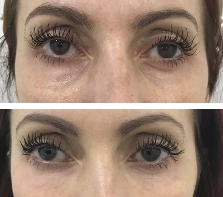 Customer photo review of Eye Roller | Eliminates Dark Circles & Puffy Eyes