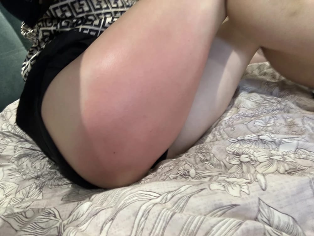 Customer photo review of Revimus Anti-Cellulite Massager