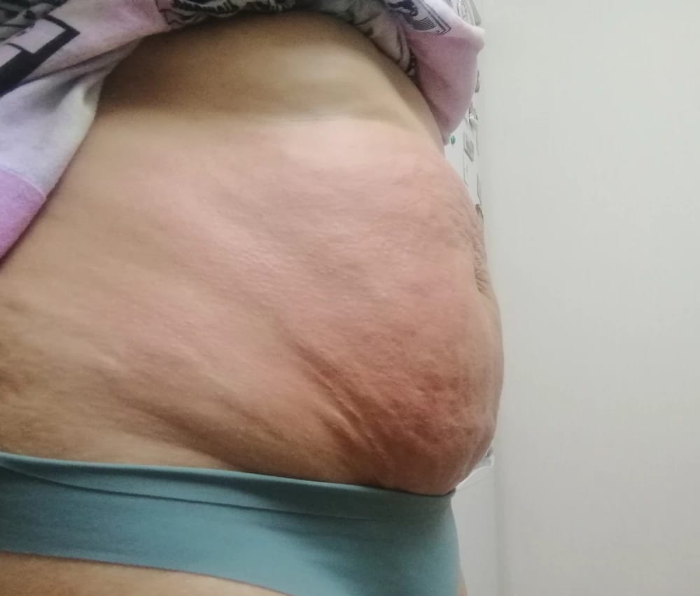 Customer photo review of Revimus Anti-Cellulite Massager