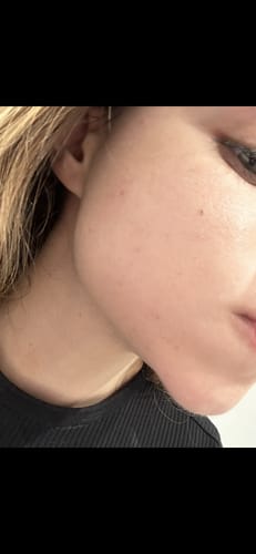Customer photo review of Intermediate Acne Program™