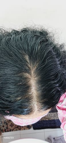 Customer photo review of INVISIBLE COVER-UP PATCH