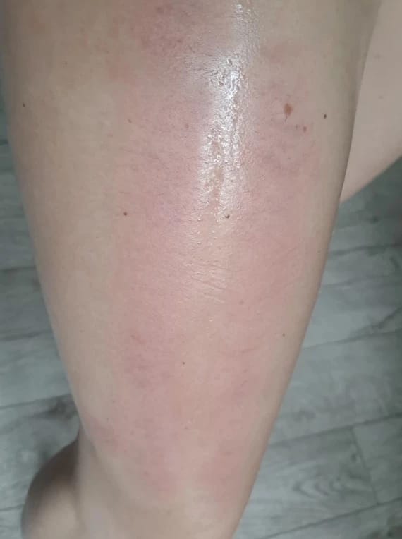 Customer photo review of Revimus Anti-Cellulite Massager