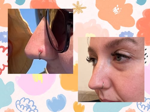 Customer photo review of Piercing Bump Treatment - Bump, Keloid & Scar Relief Oil