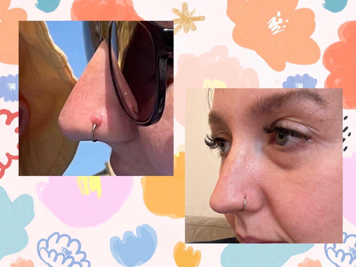 Customer photo review of Piercing Bump Treatment - Bump, Keloid & Scar Relief Oil