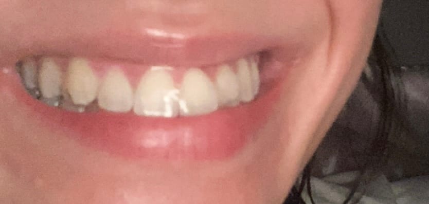 Customer photo review of REORDER-Upper Retainer