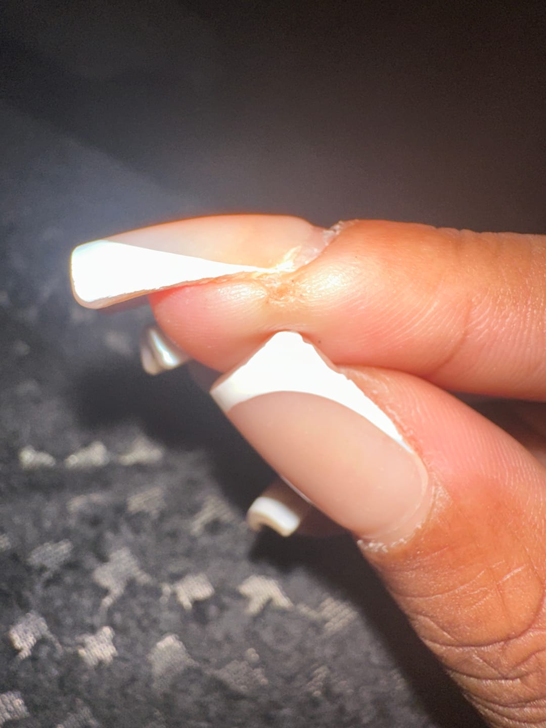 Customer photo review of The Wartabater | Electronic Wart Remover | Safe, Easy, & Effective