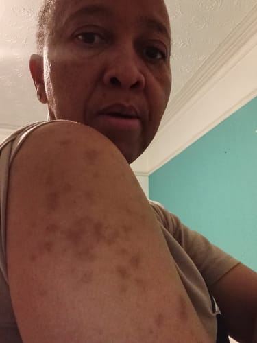 Customer photo review of Anti-Acne & Dark Spots African Soap