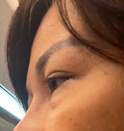 Customer photo review of EvenSkyn® Venus: Premium Eyelid Anti-Aging Device