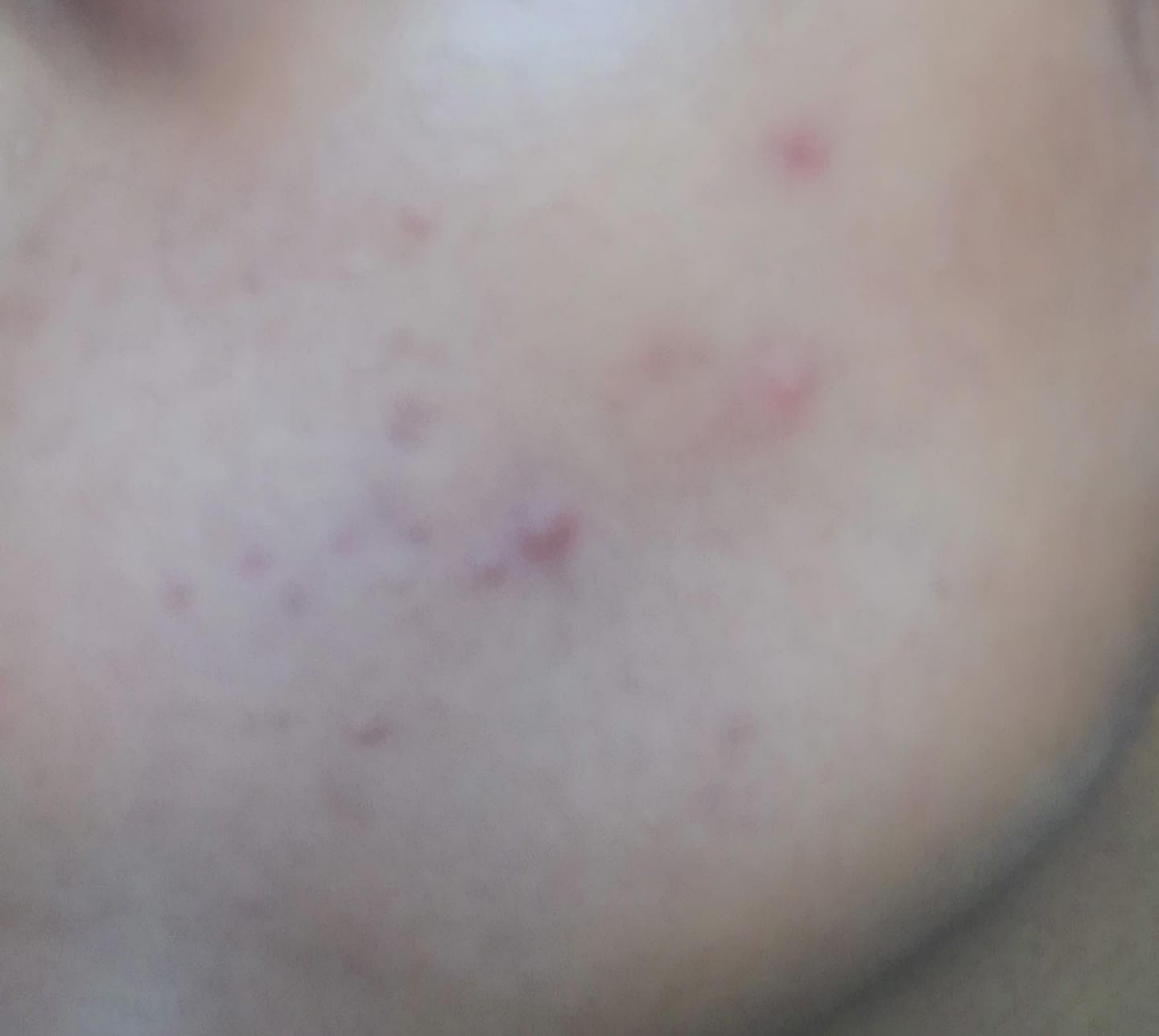 Customer photo review of ACNE CLARIFYING SERUM - Energetic Skin Therapy for Acne & Scars