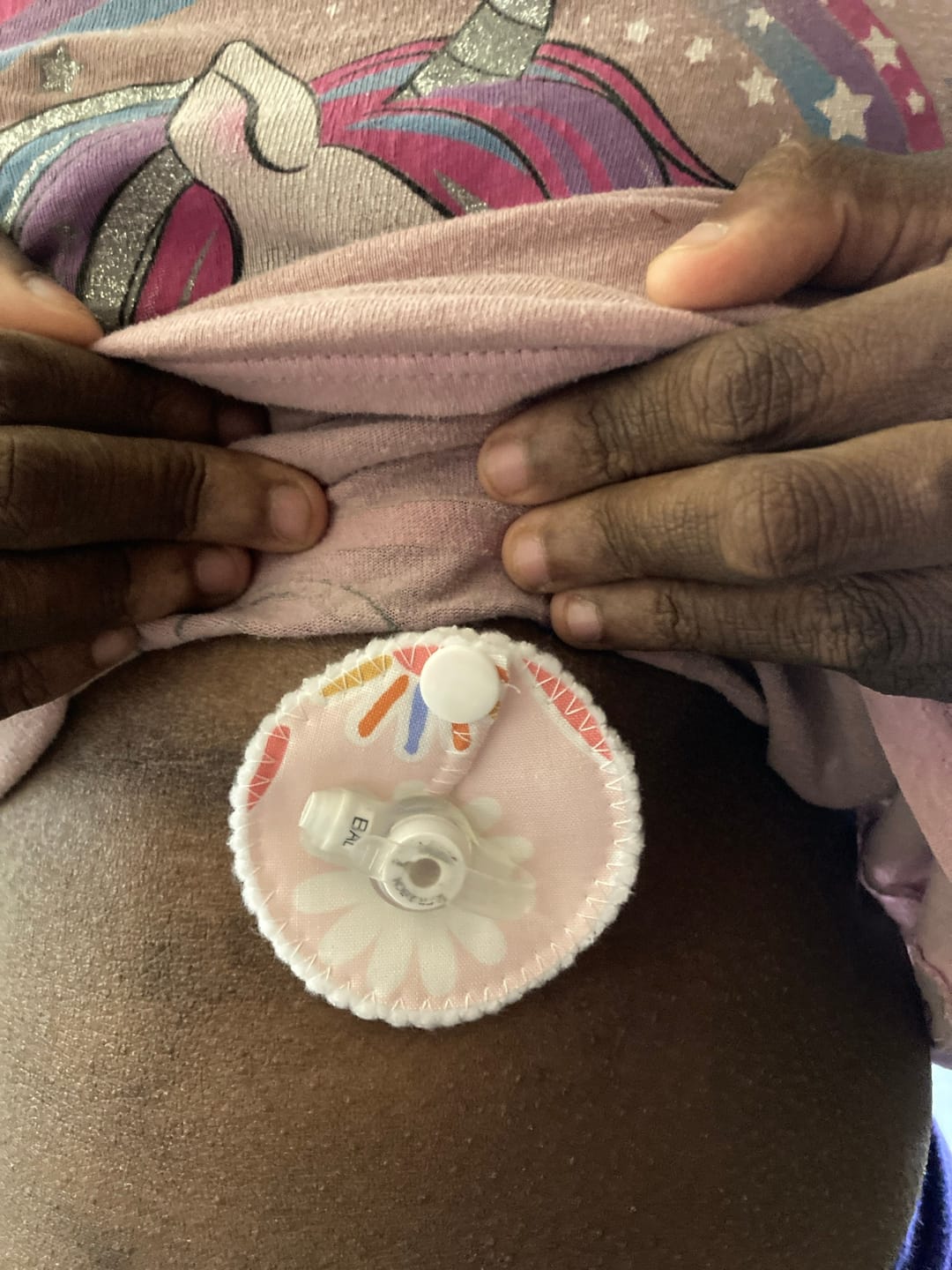 Customer photo review of Set of 7 G tube pads / gtube pads / g-tube pads / gtube covers / feeding tube pads / g tube covers / mic-key button cover / AMT mini button