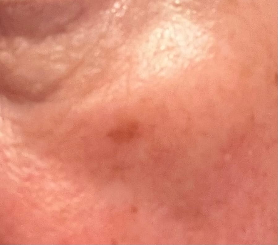 Customer photo review of Dark Spot Micro Dart Patches (with Turmeric)