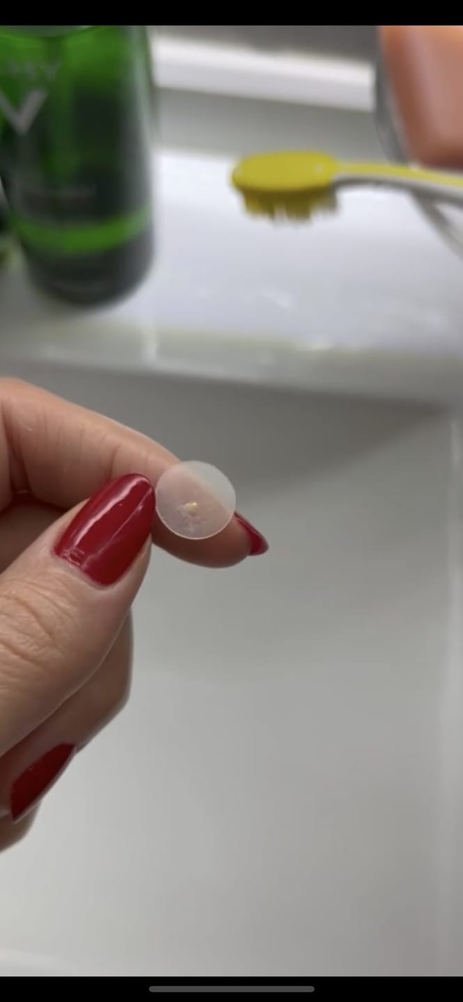 Customer photo review of Day & Night Acne Patches