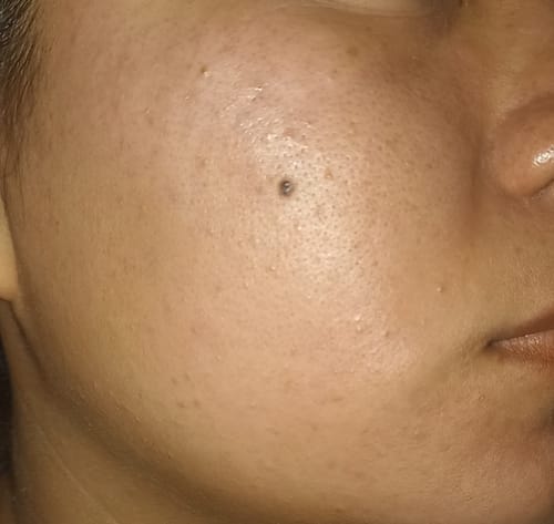 Customer photo review of Kit Restaurador (30% OFF) - Limpiador Facial 235ml + Tónico Facial 350ml + Serum de Vitamina C 30ml + Serum de Niacinamida 30ml