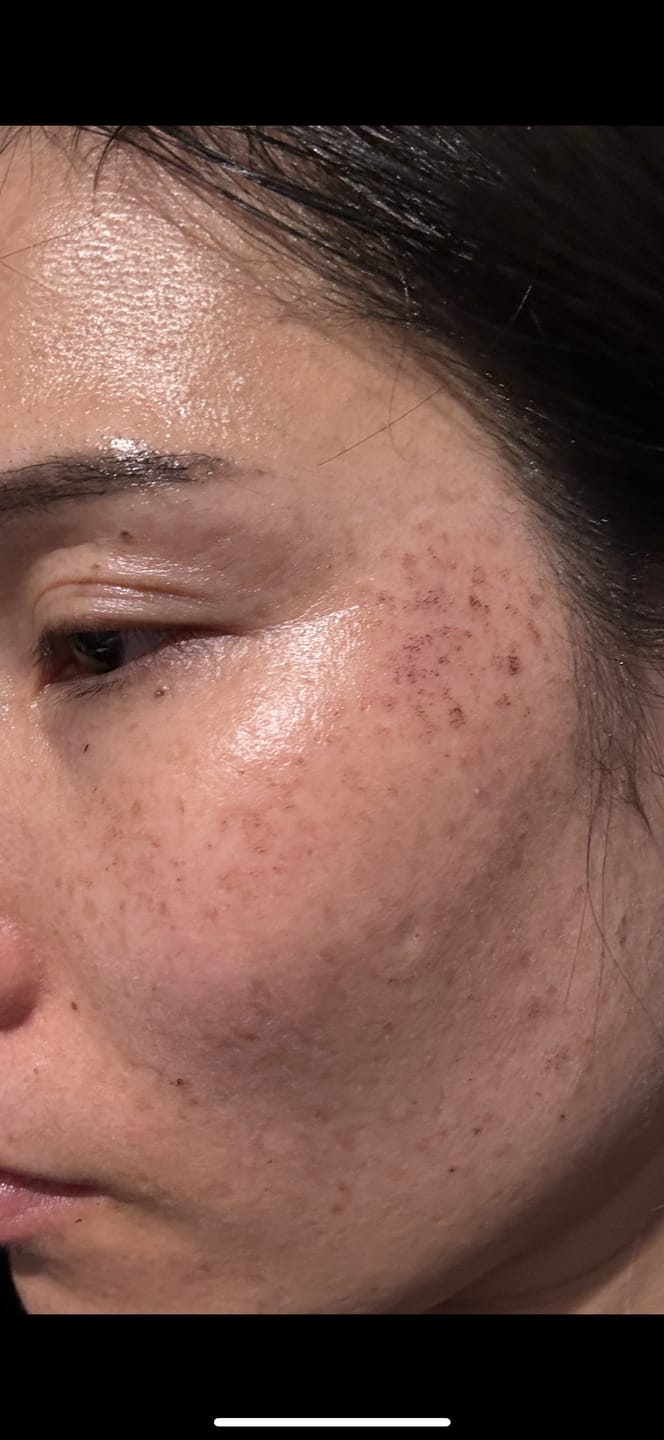 Customer photo review of JOVS Blacken PRO DPL Photofacial Skincare Device