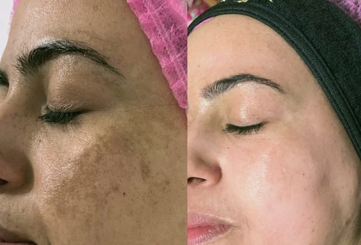 Customer photo review of Ultra C: Vitamin C Serum
