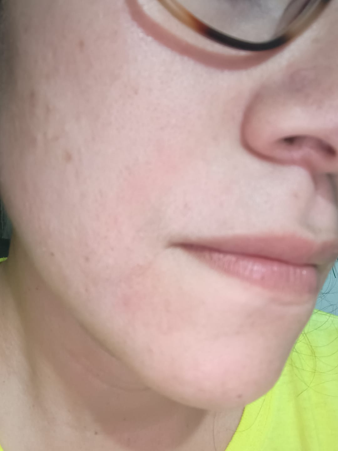 Customer photo review of NUEVO: Kit Piel Deslumbrante (47% OFF) - Limpiador + Tónico + Serum Vitamina C + Serum Niacinamida + Serum Ácido Glicólico + Serum Ácido Hialurónico + Contorno de Ojos