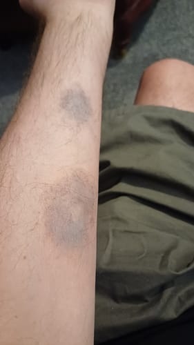 Customer photo review of Bruise Gel by Glynn Mckay