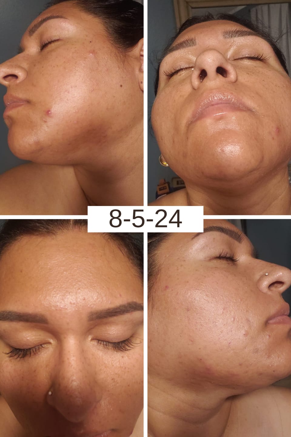Customer photo review of The Complete Acne System for Women