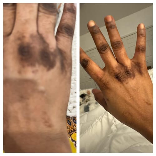 Customer photo review of Dark knuckle- Dark Spots Remover Serum