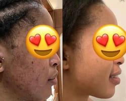 Customer photo review of Bright Skin Tea Tree Acne Set