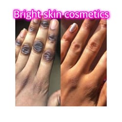 Customer photo review of Dark knuckle- Dark Spots Remover Serum