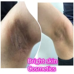 Customer photo review of Dark knuckle- Dark Spots Remover Serum