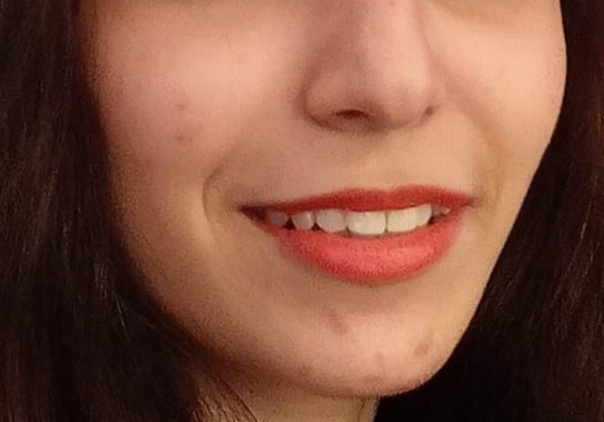 Customer photo review of ACNE CLARIFYING SERUM - Energetic Skin Therapy for Acne & Scars