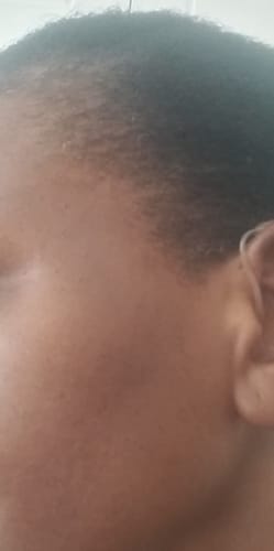 Customer photo review of Anti-Acne & Dark Spots African Soap