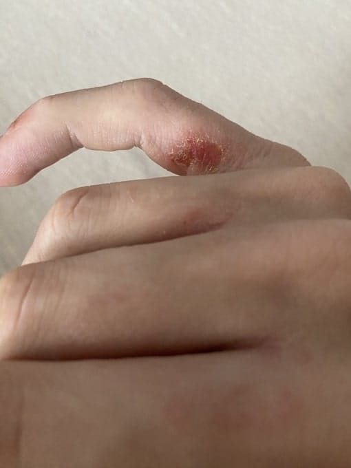 Customer photo review of EczPro - 13 Strains Probiotics for Eczema, 20 Billion CFU