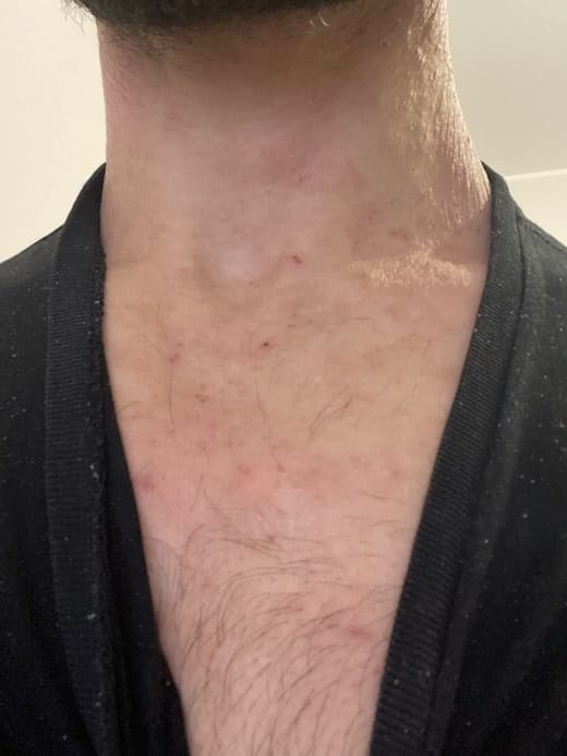 Customer photo review of EczPro - 13 Strains Probiotics for Eczema, 20 Billion CFU