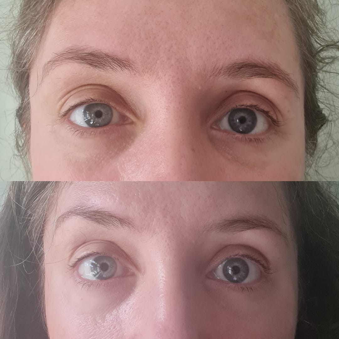 Customer photo review of Anti-Fatigue Eye Mask