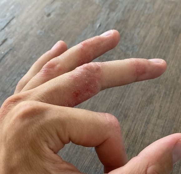 Customer photo review of EczPro - 13 Strains Probiotics for Eczema, 20 Billion CFU
