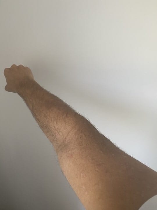 Customer photo review of EczPro - 13 Strains Probiotics for Eczema, 20 Billion CFU