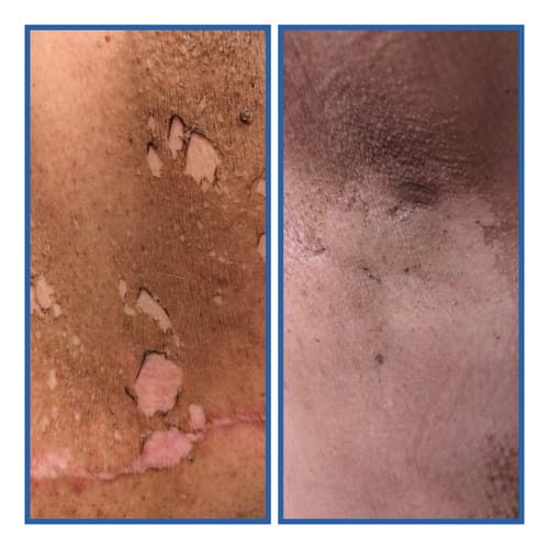 Customer photo review of Radiation Relief Cream – Unscented Burn Cream for Radiation Therapy