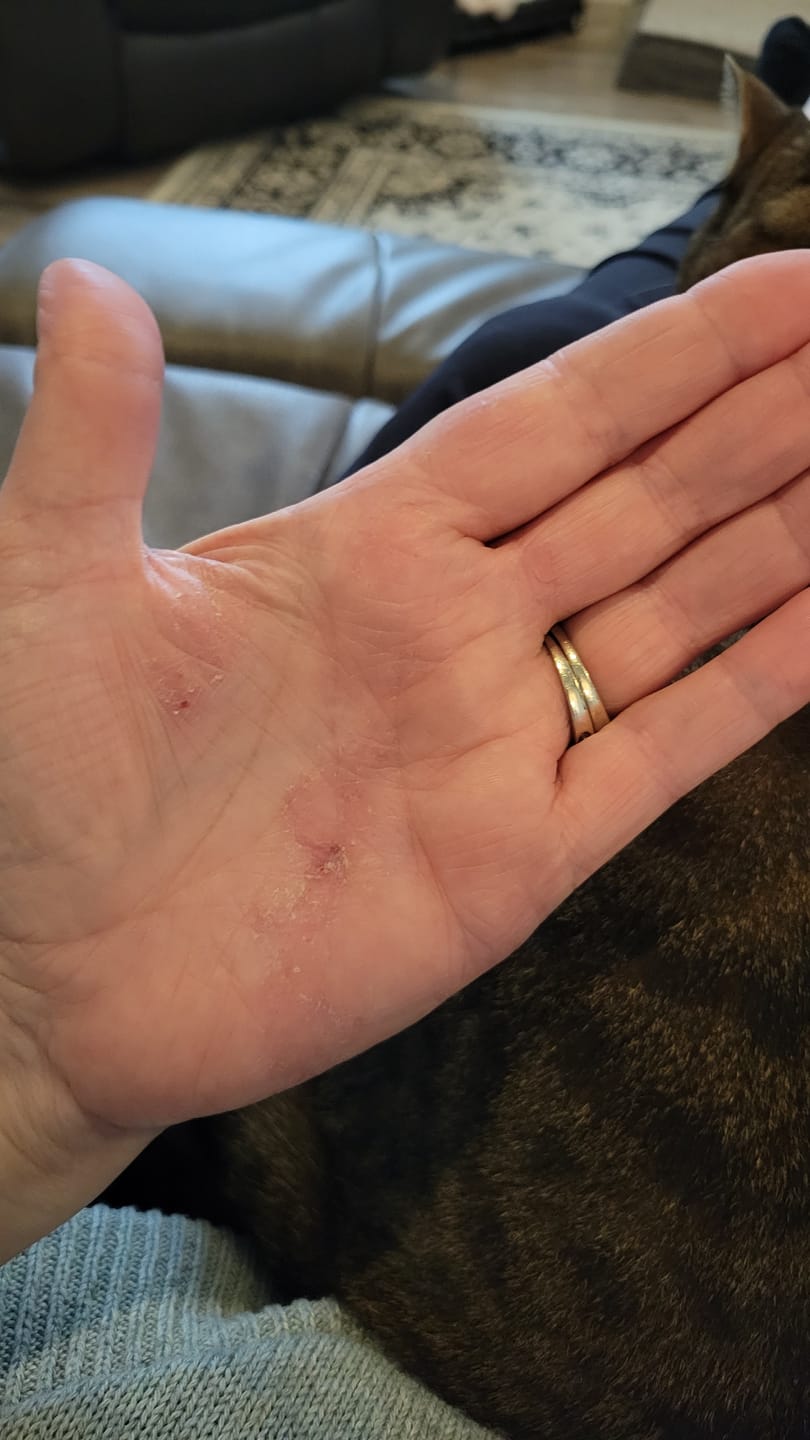 Customer photo review of Psoriasis Honey Skin-Renewing Cream