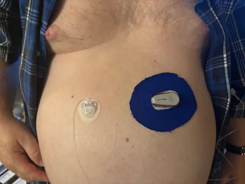 Customer photo review of Skin Grip Original - Dexcom G6 Patches