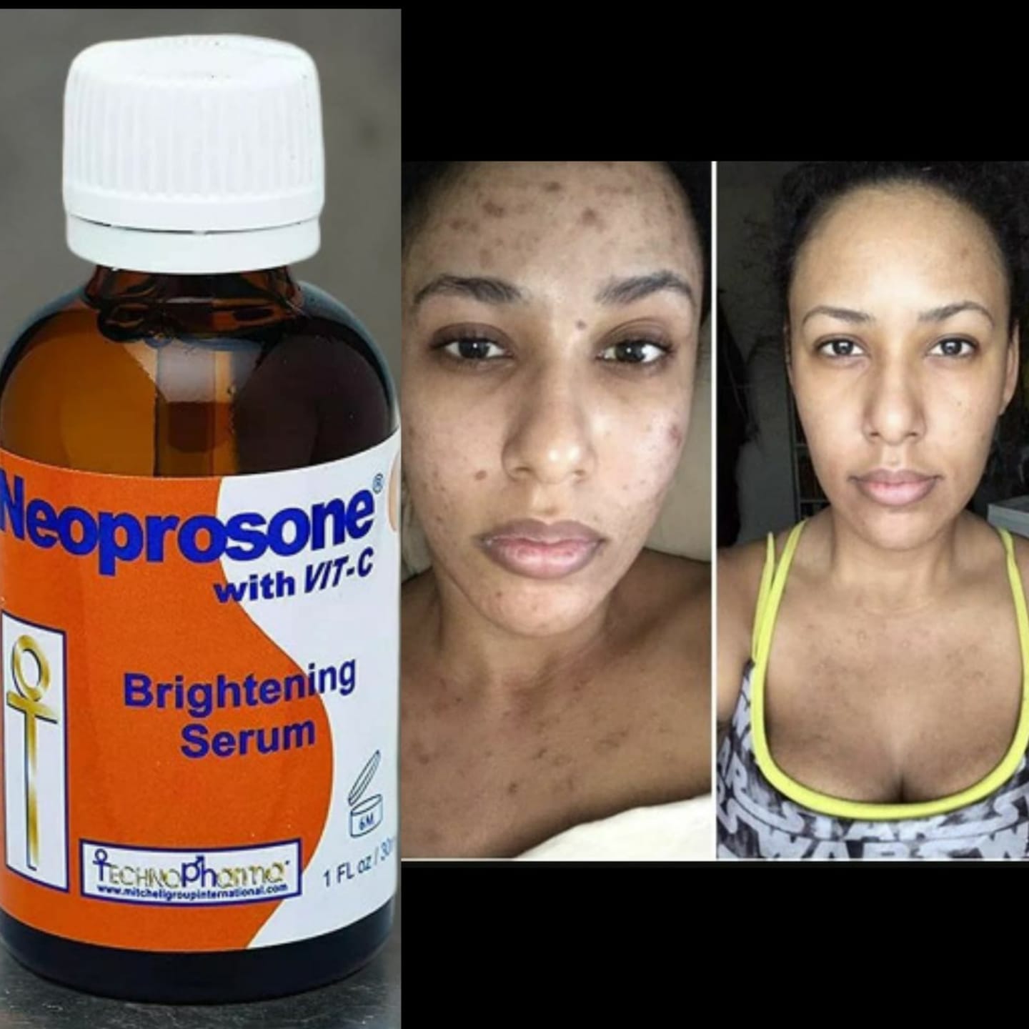 Customer photo review of Neoprosone Brightening Cream with Vitamin C - 50g / 1.75 Fl Oz