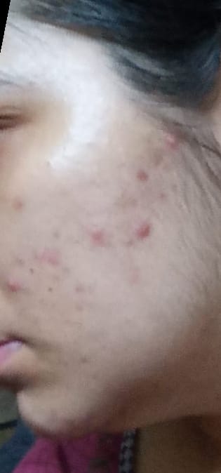 Customer photo review of ACNE CLARIFYING SERUM - Energetic Skin Therapy for Acne & Scars