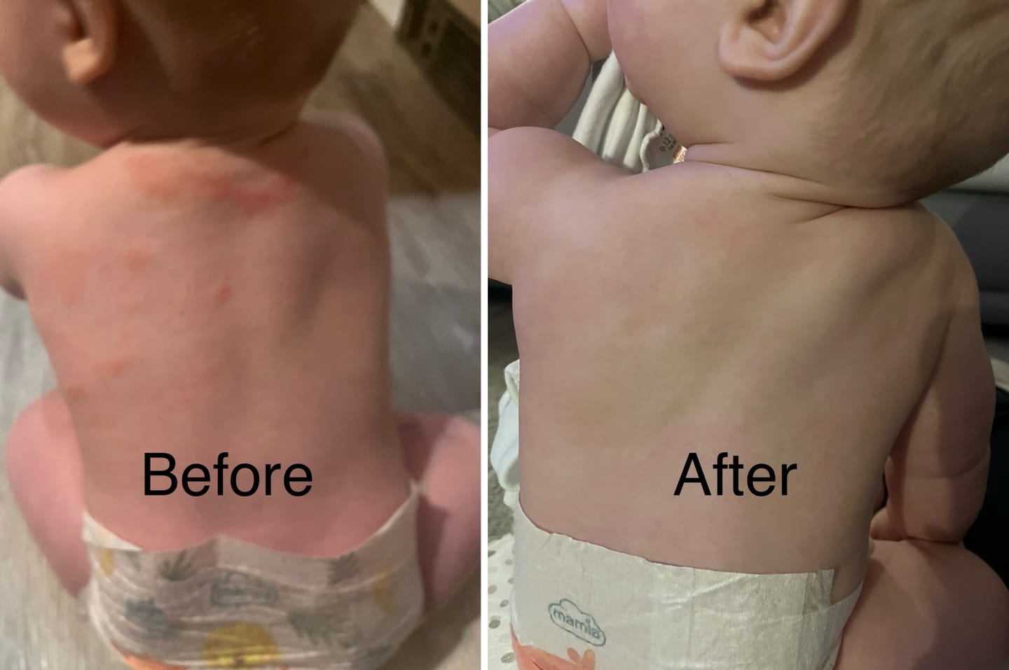Customer photo review of Bioskin Junior Outbreak Rescue Cream