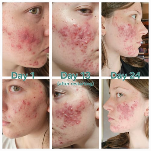 Customer photo review of Intermediate Acne Program™