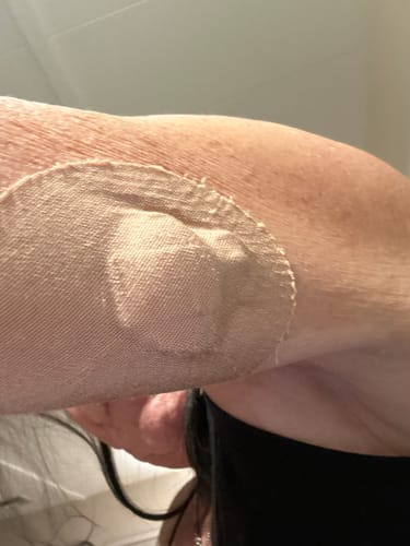 Customer photo review of Skin Grip Original - Medtronic Guardian/Enlite Adhesive Patches