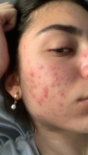 Customer photo review of Intermediate Acne Program™