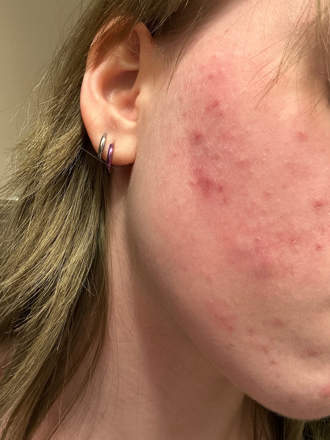 Customer photo review of 272 CT Pimple Patches Variety Pack w/ Tea Tree Oil, Salicylic Acid & Calendula Oil