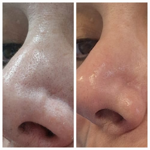 Customer photo review of Ilso - Patchs pour le nez anti-points noirs