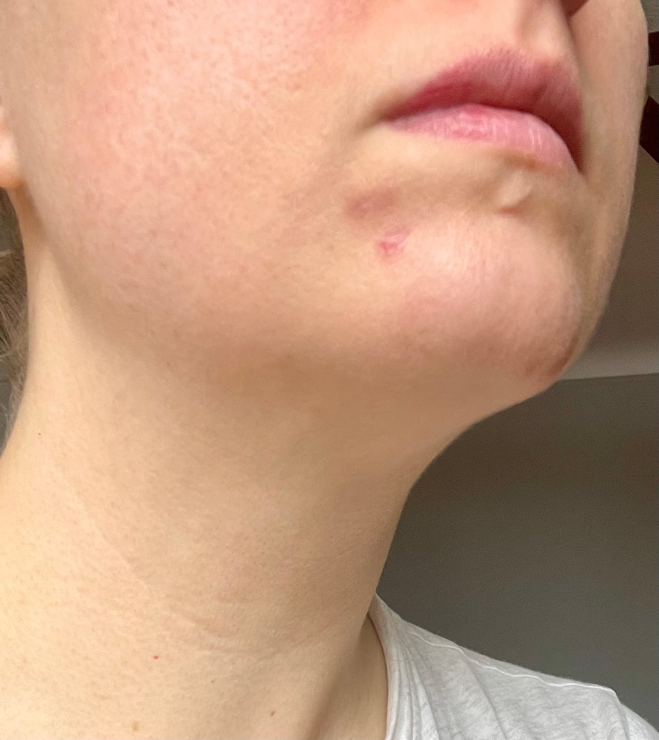 Customer photo review of Instant Rosacea, Acne & Redness Stopper