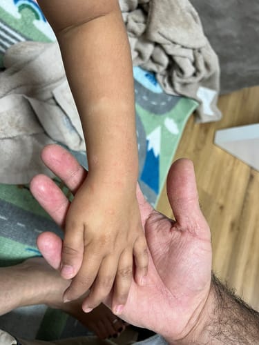 Customer photo review of ערכה טיפולית לעור אטופי ויבש | CALM