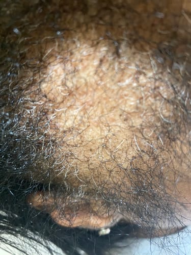 Customer photo review of Scalp Stimulator- 3 Month Supply