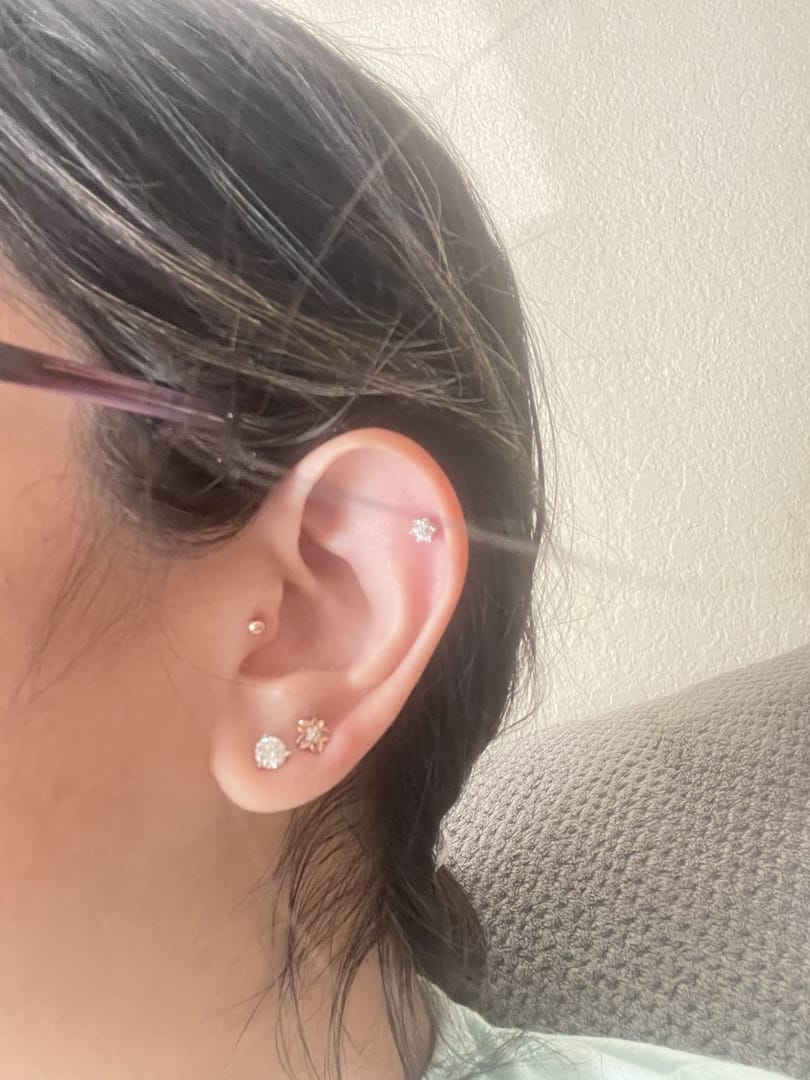 Customer photo review of 14K Gold Internally Threaded Mini Ball Labret Piercing 2mm 2.5mm 3mm 18G16G